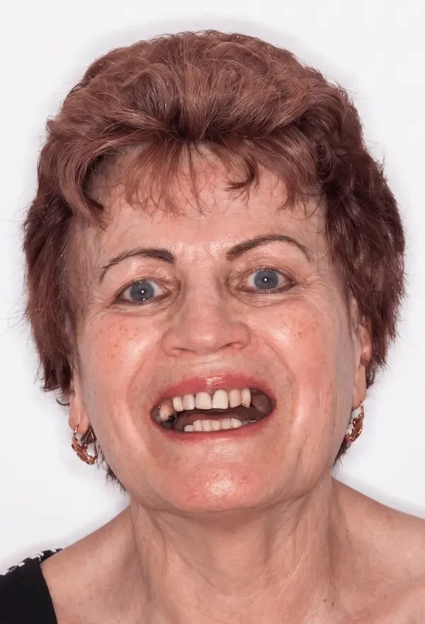 Stav pred — ošetrenie implantátmi