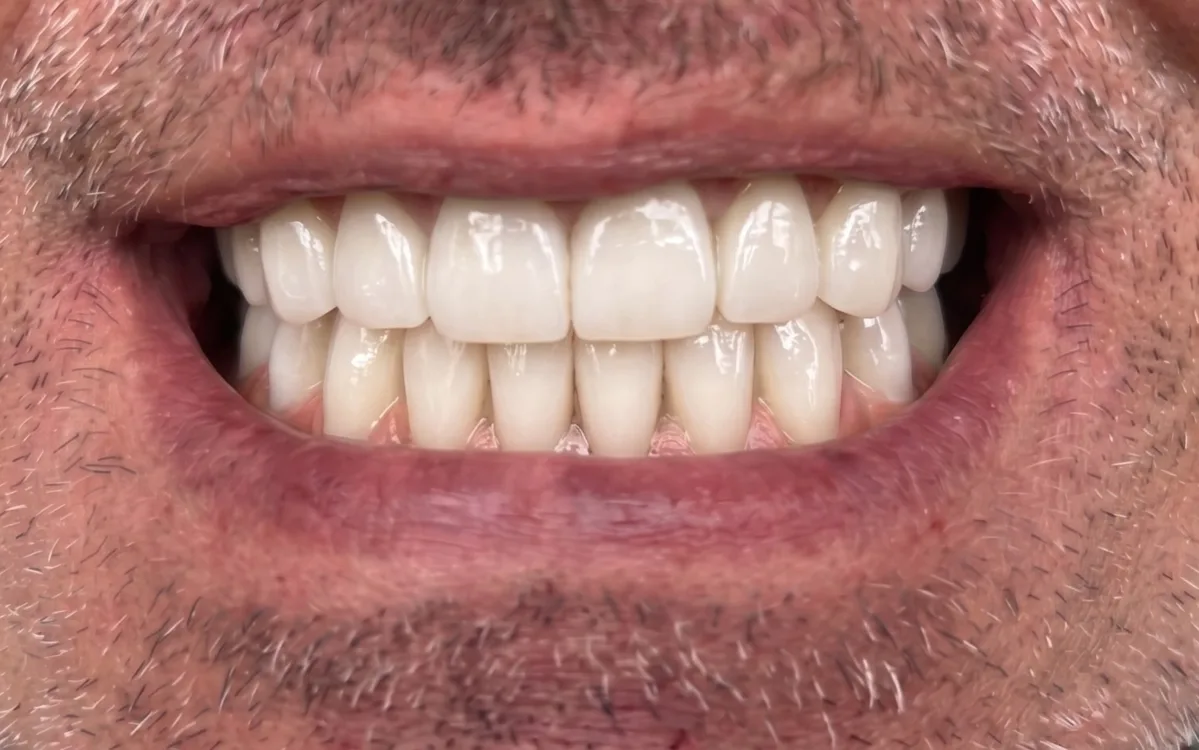 Stav po — premena chrupu implantátmi