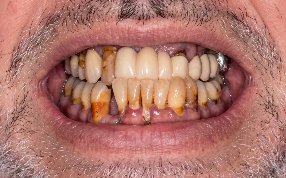 Stav pred — premena chrupu implantátmi